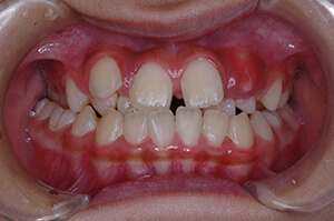 横の歯のかみ合わせが反対（交叉咬合・鋏状咬合）写真
